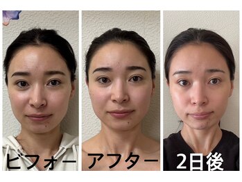 アクアナチュラ(ACQUANATURA)/小さいお顔も更に小顔に!