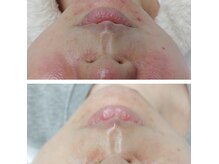 ココスタイルビューティー(COCOSTYLE beauty)の雰囲気(ララピール 一回のケアにて!)