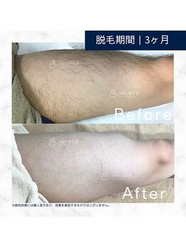 メンズクリア 高知帯屋町店/【メンズクリア】お客様の施術例
