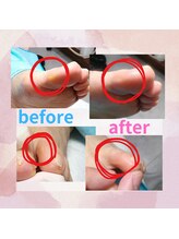 ドクターネイル爪革命 長野店/【たこ・うおのめ】リラク/足裏