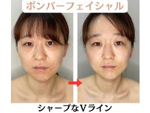コトハ(cottha)/1回施術後