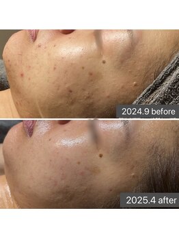 ロッタ エクリュ(Lotta ecru+)/REVI剥けないハーブピーリング