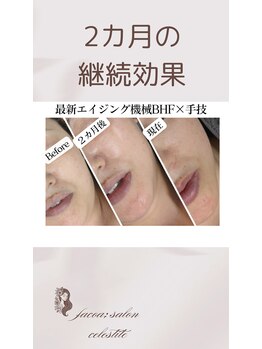 フェイシャルサロン セレスタイト/2カ月後の継続効果