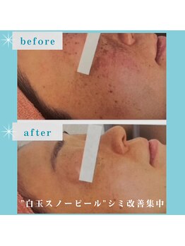 ウィッシュ 与野(Wish)の写真/《最新ケア☆白玉スノーピール》シミ改善集中！透明感＆ツヤ肌実感！口コミ高評価【20%OFF→14,000円♪】