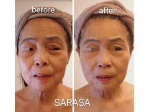 サラサ(SARASA)/エイジング　目の下のたるみケア