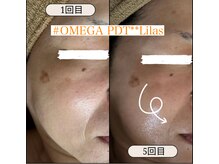 リラ(Lilas)/細胞へアプローチできる