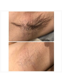 エンルーチェ(enluce)/【天六・梅田】シミケア