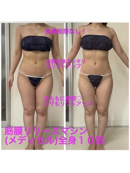 セルビューティー(Cell Beauty)/30代、筋膜リリース全身10回