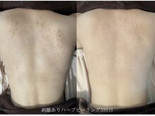 アイル 江坂店(iru)/大人気！背中ハーブピーリング