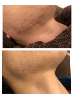 ヴィヴ コレビ(VIV COREBI)/大人の悩み肌