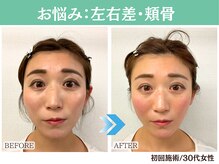 ナチュラルビューティーフェイス 横浜(NBF)/頬骨・左右差 / 30代