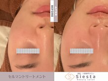 シエスタ(siesta)/セルマン艶玉肌トリートメント