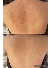 リラ(Lilas)/背中ビフォーアフター