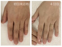 キレイテ 上野店/40代/4回目【ハンドケア上野】