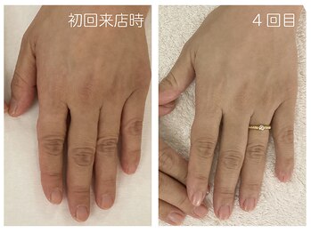 キレイテ 上野店/40代/4回目【ハンドケア上野】