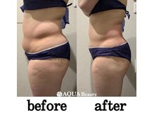 ビーエスアクアビューティー/部分ケアマシン