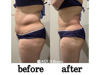 ビーエスアクアビューティー/部分ケアマシン