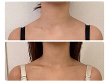 モナンジュ(ramonange)/デコルテ　before after