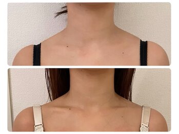 モナンジュ(ramonange)/デコルテ　before after