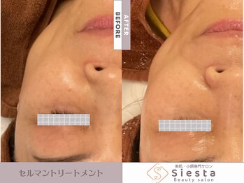 シエスタ(siesta)/セルマン艶玉肌トリートメント