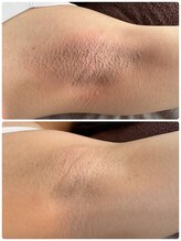 サンタ(santa)/脇脱毛ビフォーアフター