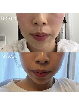 ビューティーサロン プティ(beauty salon petite)/レモンボトルでお顔の脂肪分解