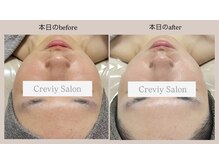 クレヴィー(Creviy)/3セットコース