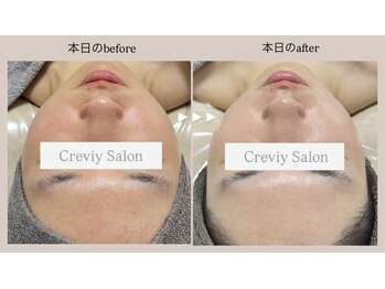 クレヴィー(Creviy)/3セットコース