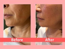 オーダーメイド痩身&小顔矯正専門店Re:Lives【リライブ】金町店の雰囲気(レモンボトル&レッドショットで30代~からの小顔美肌を実現♪)