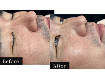 ハル(HAL)/ビフォーアフター/光フォト