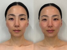 ルナ クレッシェンテ(Luna crescente)/表情筋エクササイズでメリハリ顔