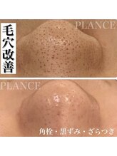 プランス 福岡(PLANCE)/毛穴洗浄／福岡／エステ／天神