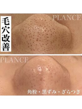 プランス 福岡(PLANCE)/毛穴洗浄／福岡／エステ／天神