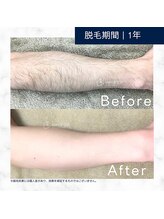 メンズクリア 高知帯屋町店/【メンズクリア】お客様の施術例