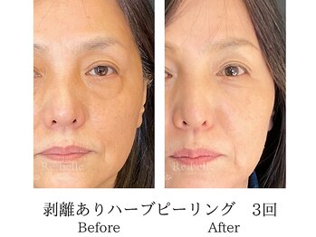 ミーシェ(Meshie)/リベルハーブピーリング施術前後