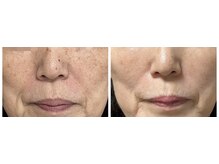 セルフエステBB あけのアクロス店/セルフホワイトニング