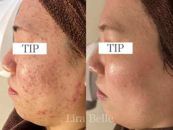 リラベル(Lira Belle)/TIPハーブピーリング