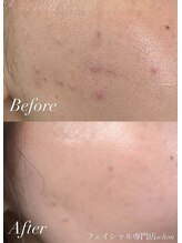 シェーン(Schon)/IPL美肌光フォト