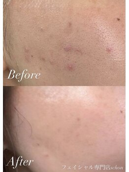 シェーン(Schon)/IPL美肌光フォト