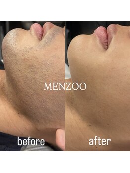 メンズー(MENZOO)/