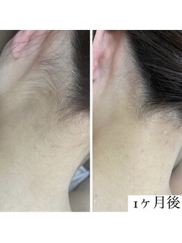 カルディエ(Cardie)/パーツ脱毛