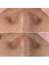 ドゥクス 難波店(Dux)/毛穴ケア