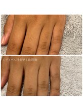エクラ(eclat)/レディース手指・甲脱毛