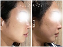 ラヴィナス 熊本下通(LaVENUS)の雰囲気（くすみケア、たるみケア、ハリ、ツヤ、小顔、リフトアップ！）