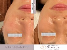 シエスタ(siesta)/セルマン艶玉肌トリートメント