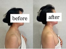 ストレートネック、頭痛、肩こり、食いしばりをどうにかしたい