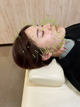 まごころ整骨院の写真/【8月号限定！】ハリネズミ美容鍼＋小顔矯正¥10250→¥7400 いつまでも若々しい印象に！