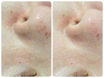 トータルビューティ ノイド(Noid)/毛穴洗浄 いちご鼻撃退コース