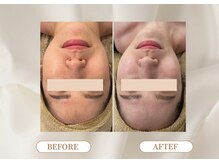 トロワ(TROIS)/小顔変化の決定版