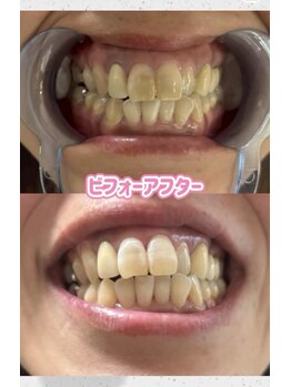 セルフホワイトニングサロン　エクシアホワイトニング宇治小倉店/ビフォーアフター